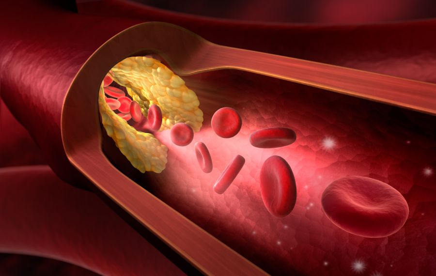Peripherar Arterial Response Peripherar Arterial Response
